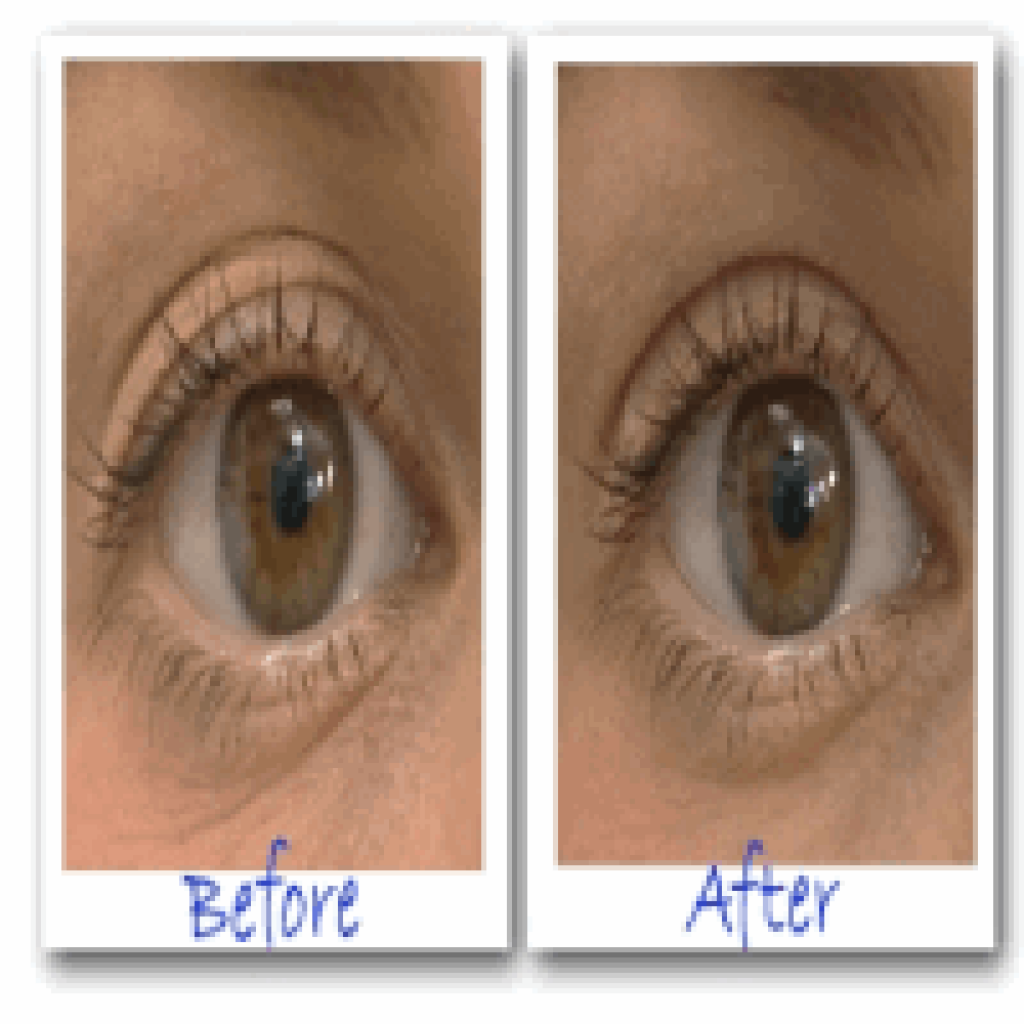 Droopy Eyelid Surgery Before And After 