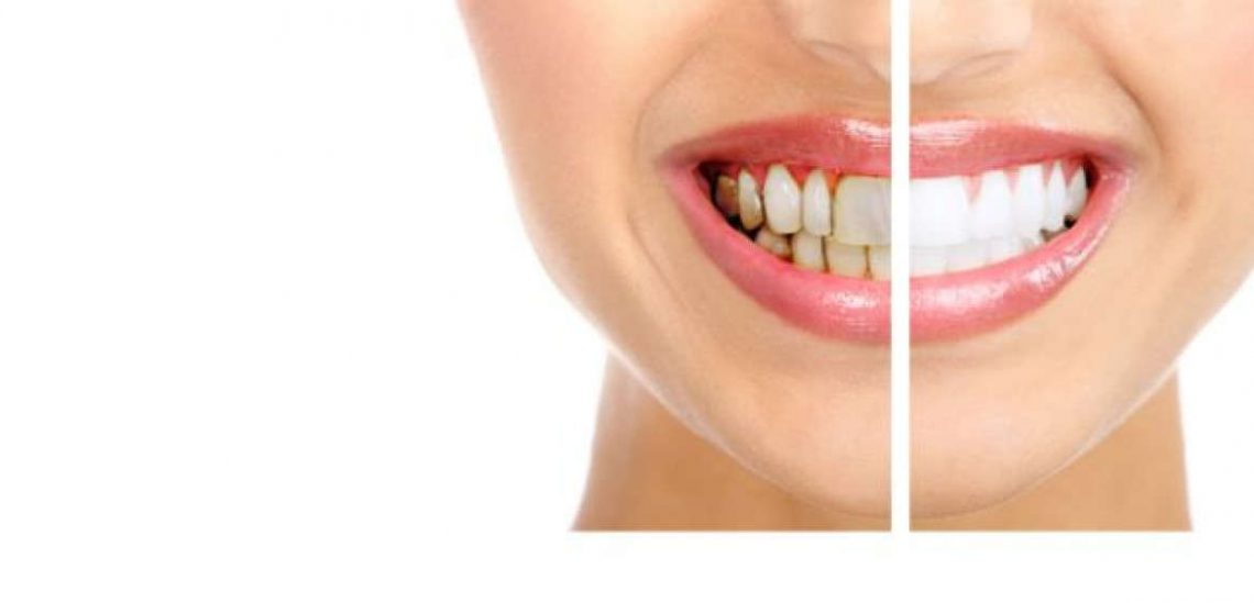 отбеливание зубов при воспалении