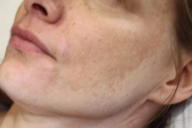 Что такое мелазма кожи лица фото до и после
