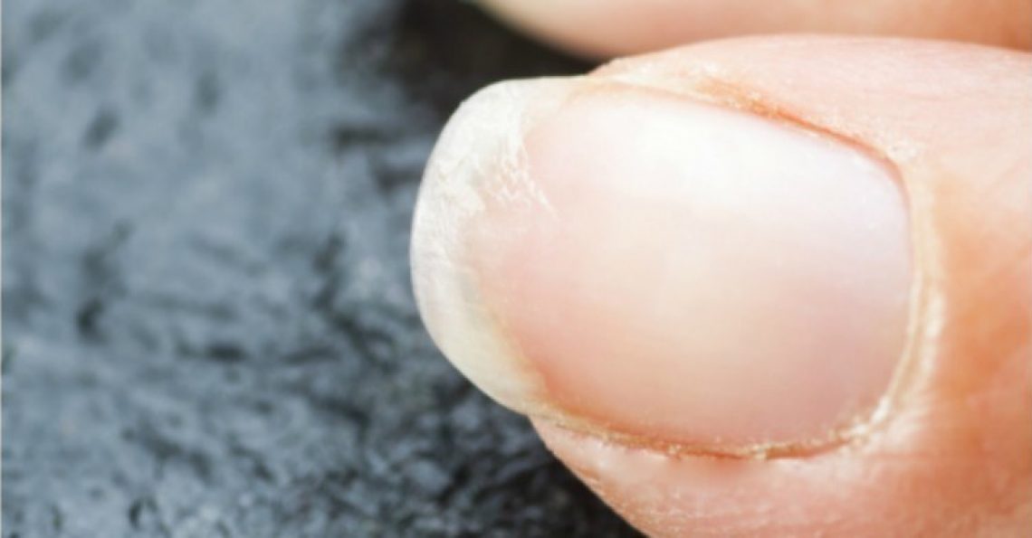 14 Surprising Causes Of Cracked Brittle Splitting Fingernails