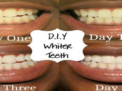 How to Get Rid of Roof of Mouth Sores: Best Home Remedies ...