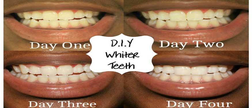 7 DIY Ways to Whiten Teeth Safely at Home - YummyLooks