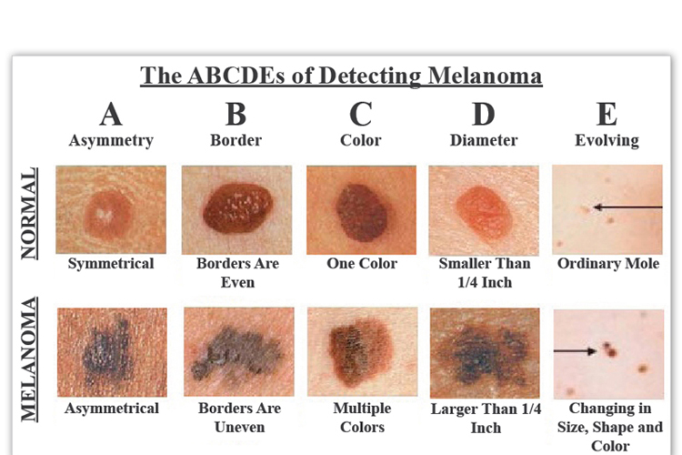 How To Check Yourself For Skin Cancer? Easy To Follow Guide - YummyLooks