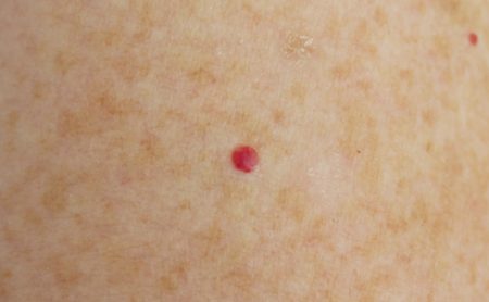 pinpoint red dots on skin