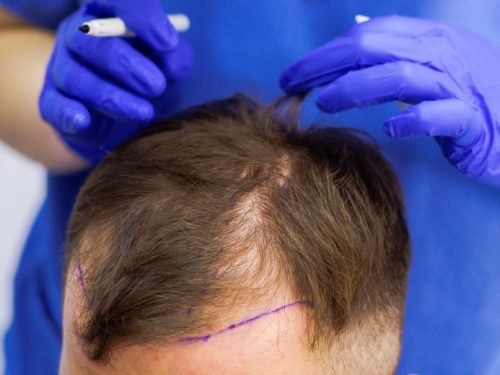 How To Accelerate Hair Growth After Hair Transplant Surgery?