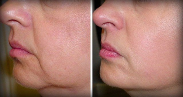 results dermapen